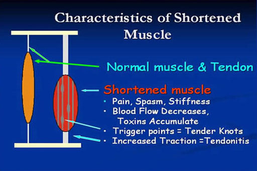 Intramuscular Stimulation  Calgary Acupuncture Clinic